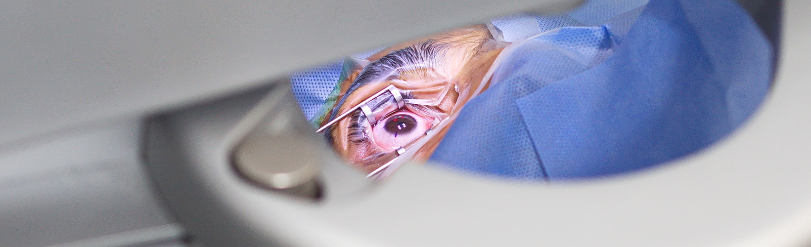 Assessing Transepithelial Surface Ablation Benefits