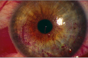 Coming to Grips with OSD in Cataract Patients