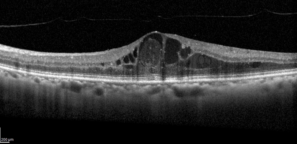 Targeting the Kallikrein-Kinin System to Treat DME