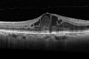 Targeting the Kallikrein-Kinin System to Treat DME