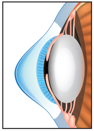 ESCRS - Tracking Keratoconus Progression with AI