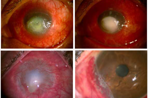 Amniotic Membrane Transplantation for Ocular Surface Disease