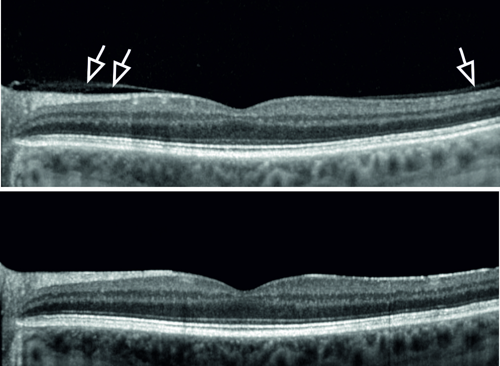 Retinal Detachment After Cataract Surgery