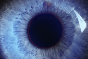 Neuroprotectant Treatment for MacTel Type 2