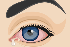 Early Intervention Improves Outcomes in Fungal Keratitis