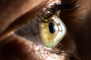 Cataract Surgery in Eyes with Keratoconus