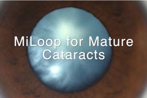 Complex Case #1: Miloop - Mature Cataract