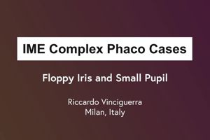 Phaco Complex Case Series: Floppy Iris and Small Pupil