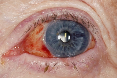 Subconjunctival haemorrhage