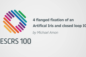 4 flanged fixation of an Artifical Iris and closed loop IOL - Michael Amon