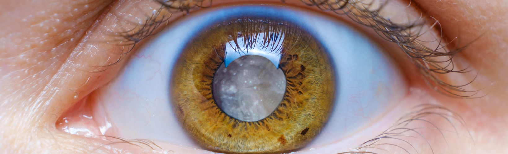 Banner image for Capsulotomy in Intumescent White Cataract?