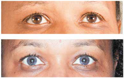 Laser procedure can turn brown eyes blue