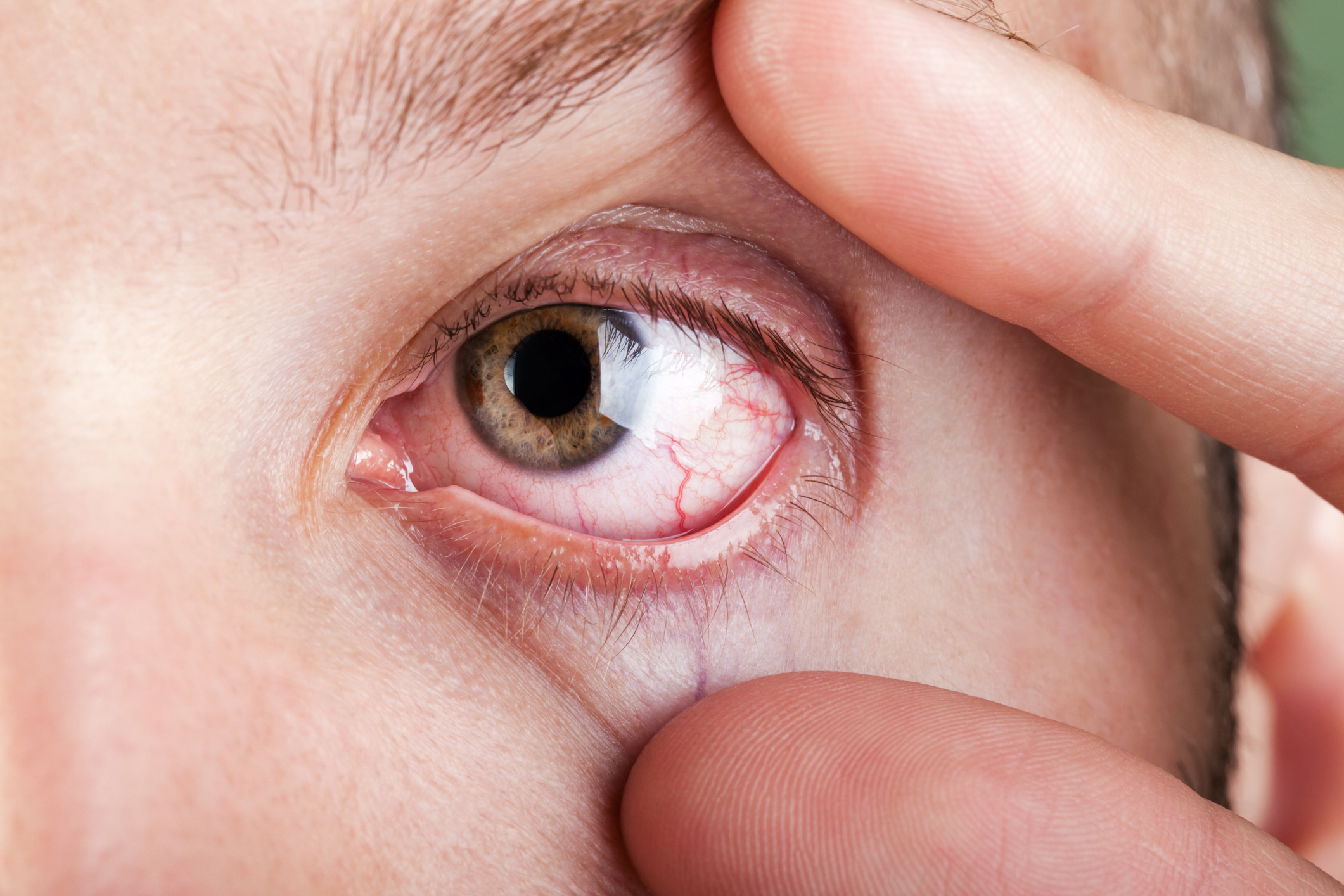 First-Line Therapy for Non-Infectious Uveitis