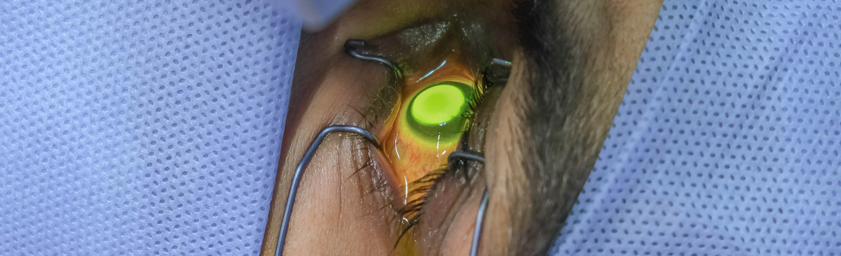 Banner image for Treating Ectasia Without Keratoplasty