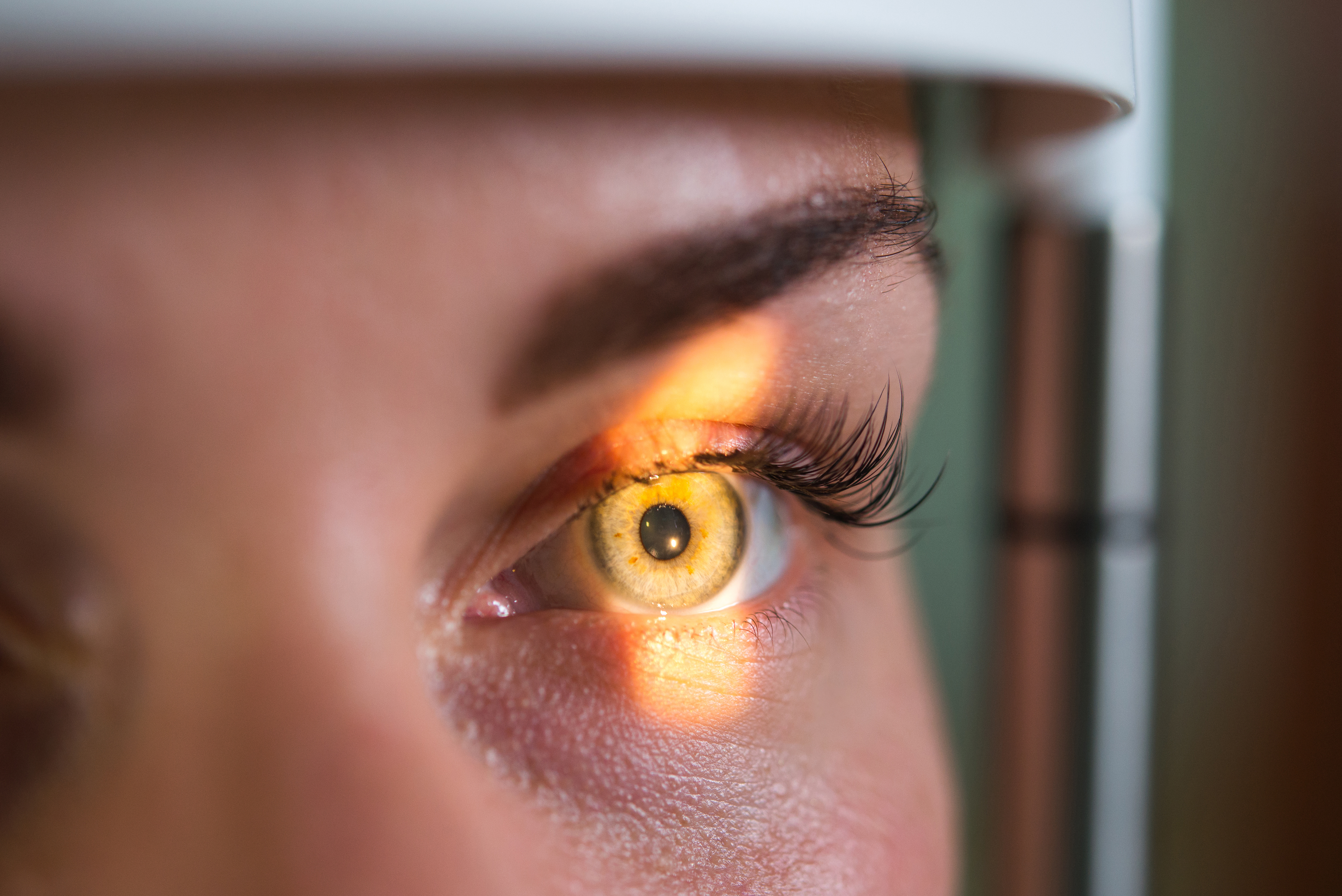 A Case of Inturning Lashes