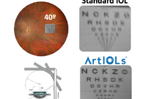 New IOL Underscores Importance of Peripheral Vision