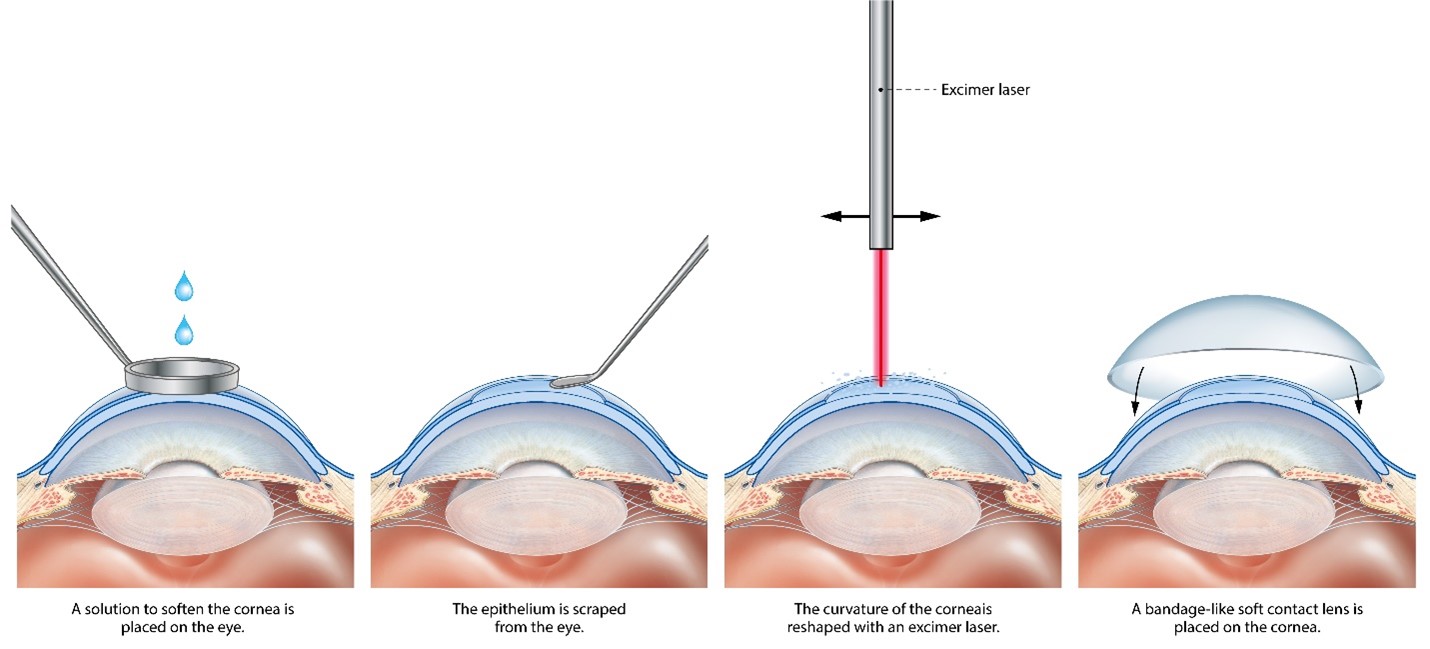 Surface laser treatments