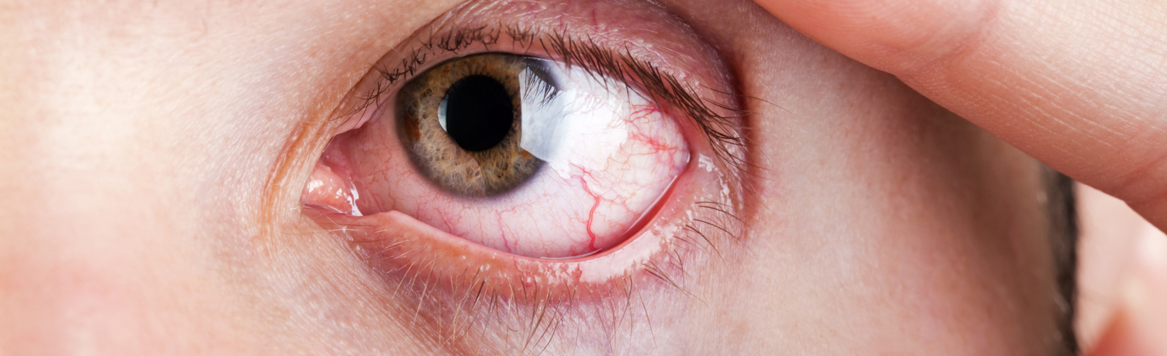 Banner image for First-Line Therapy for Non-Infectious Uveitis