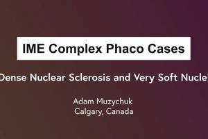 Phaco Complex Case Series: Dense Nuclear Sclerosis and Very Soft Nuclei