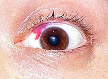 Subconjunctival haemorrhage