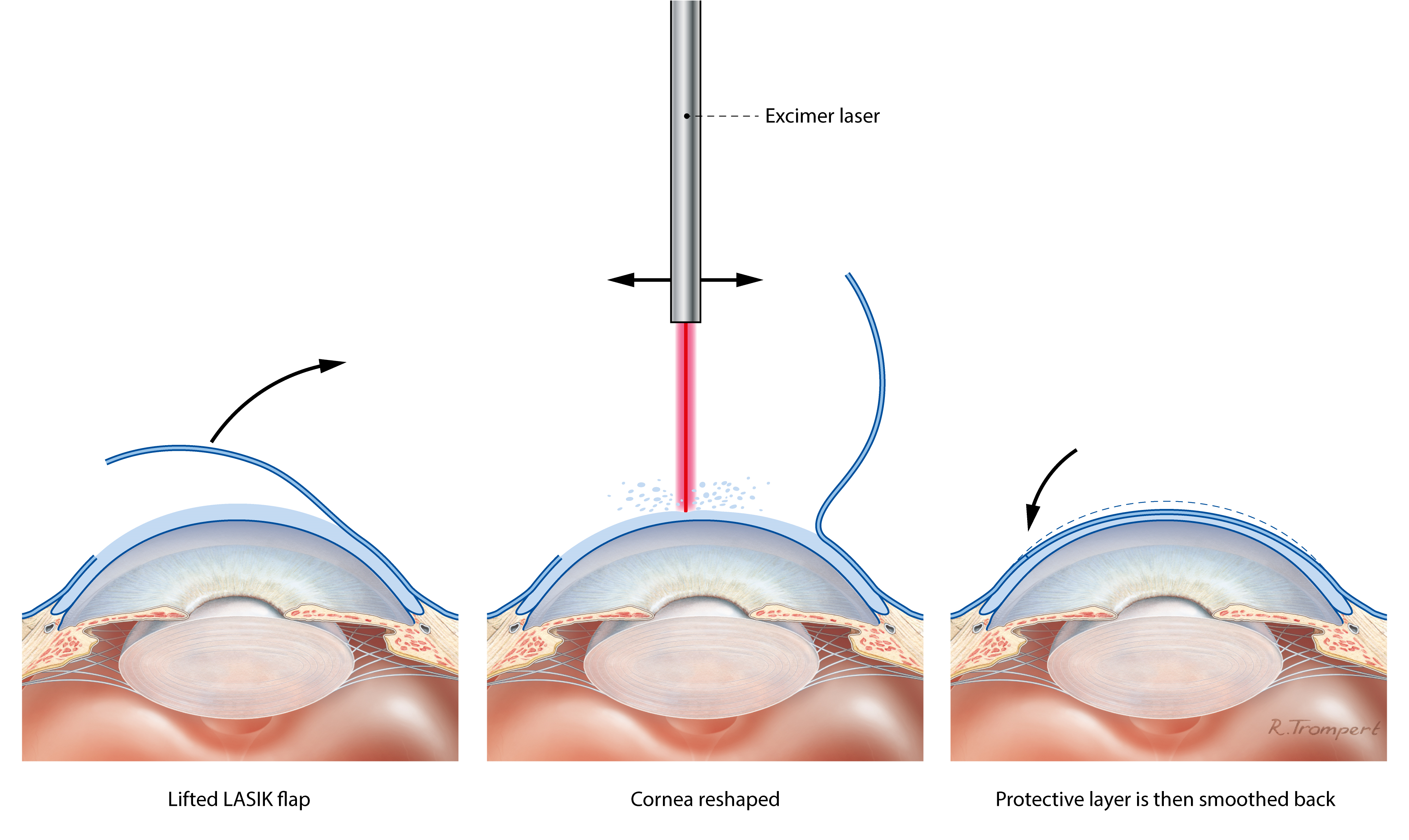 LASIK