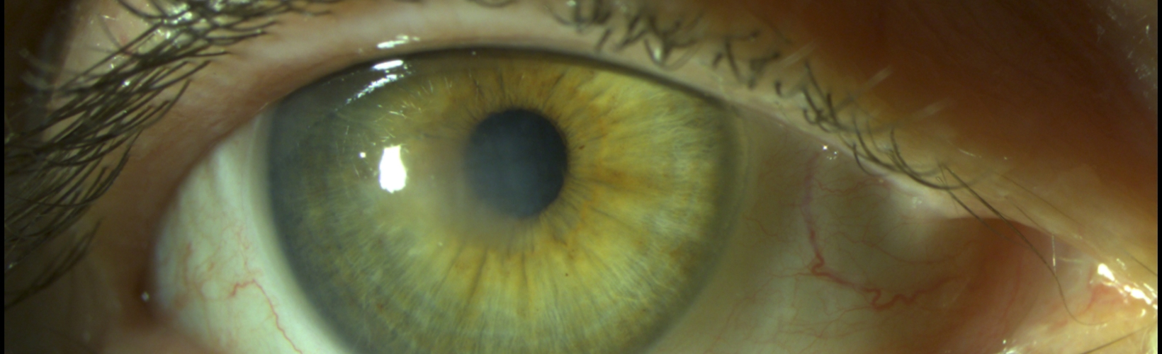 Banner image for DSO Shows Promise in Treating Fuchs' Dystrophy